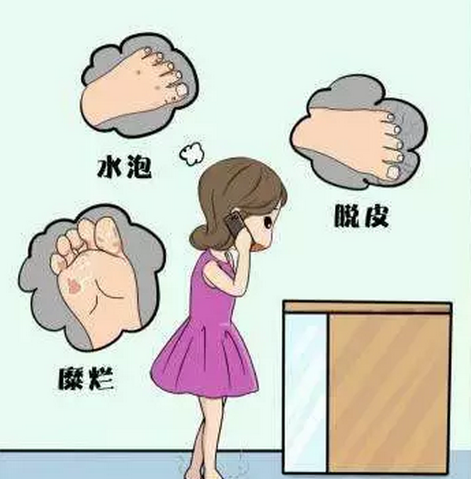 腳氣的幾種類型，有了腳氣怎么治？[漓峰消毒]